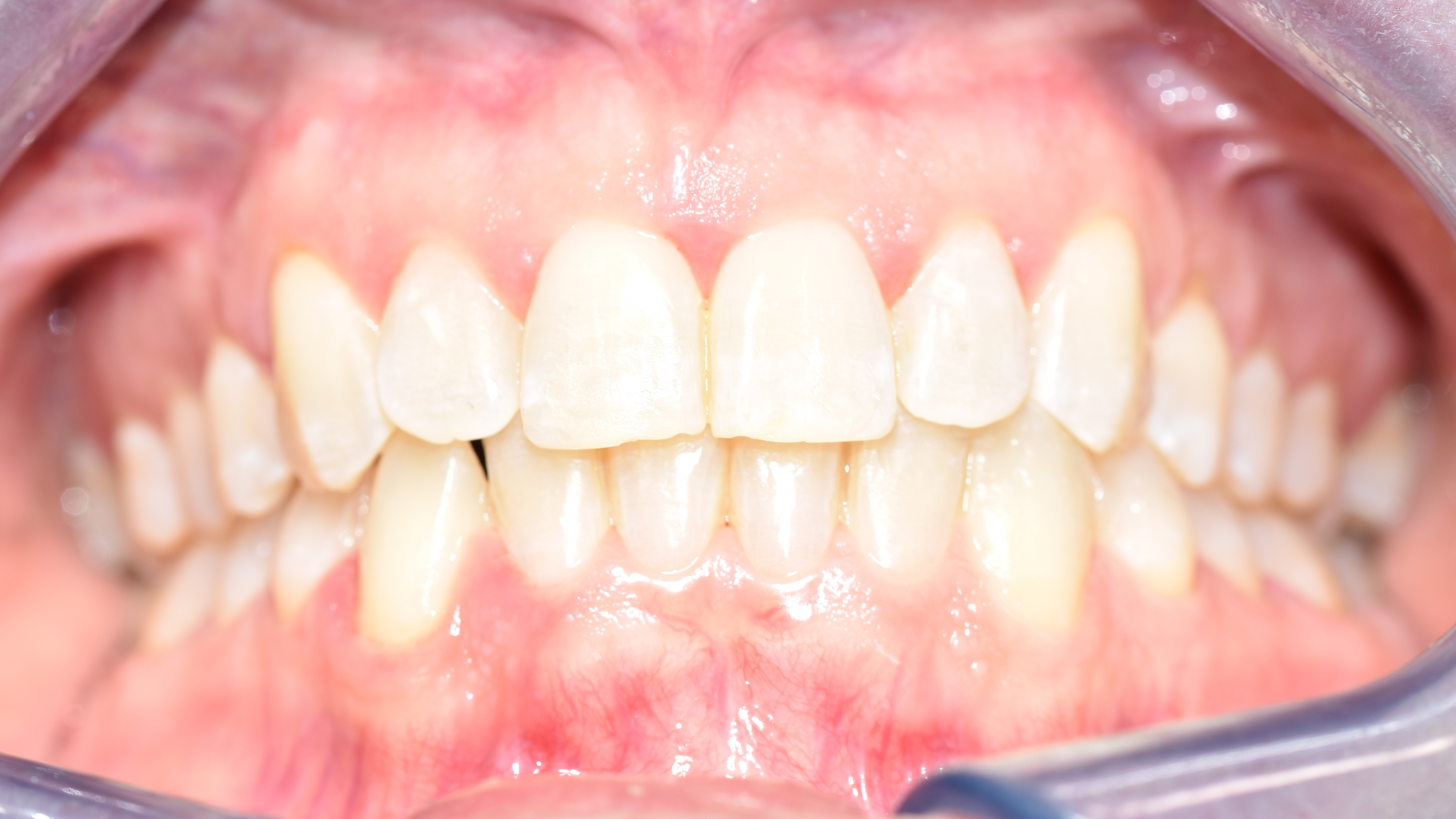 After treatment
